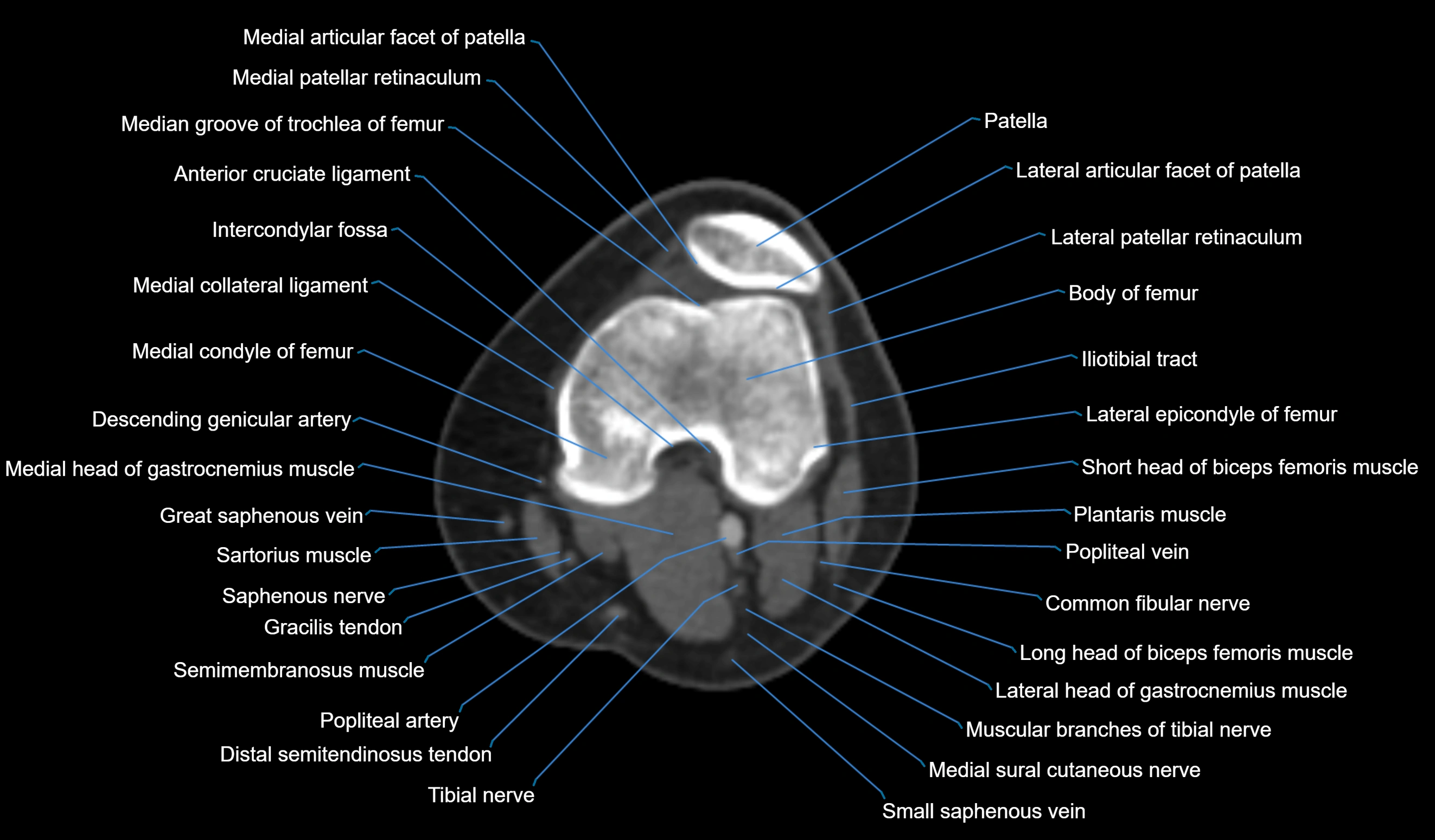 CT knee axial cross sectional anatomy labelled image-00026.webp